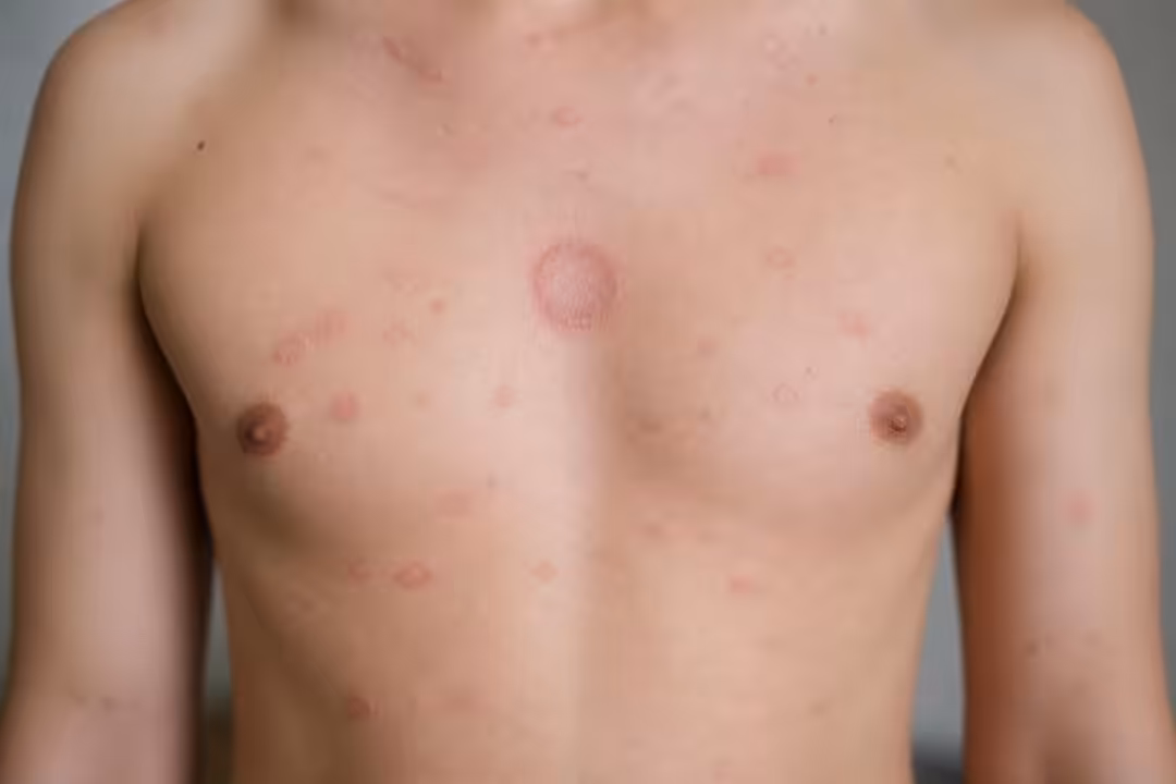 découvrez les symptômes, l'évolution et les conseils pour comprendre et gérer le pityriasis rosé de gibert, une affection cutanée fréquente et bénigne.